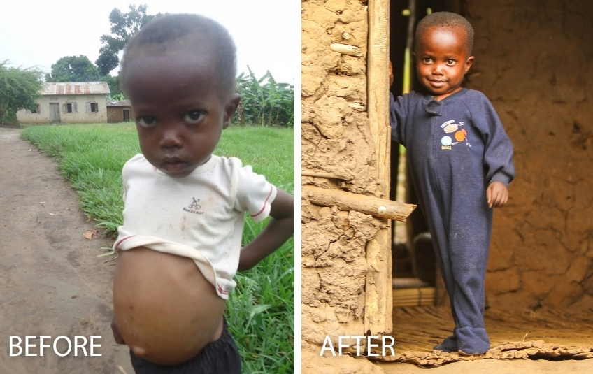 Before photo of young malnourished african toddler with swollen belly and after photo of ugandan boy healthy and smiling